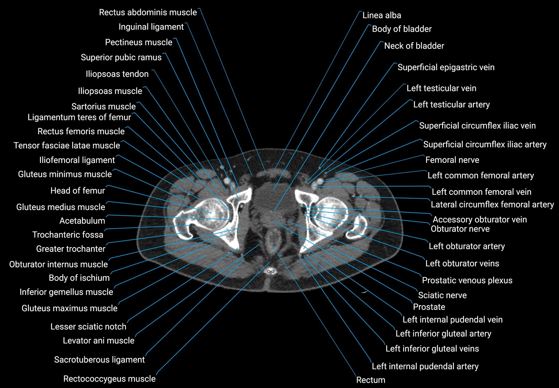 CT male pelvis axial cross sectional anatomy labelled radiology image -00191.webp